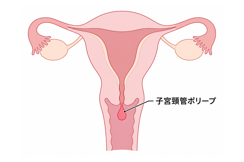 子宮頸管ポリープ