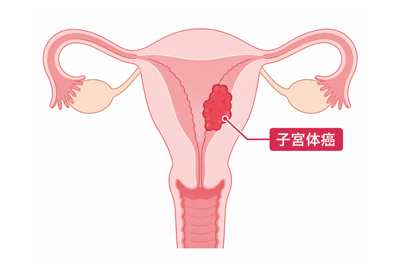 子宮体癌