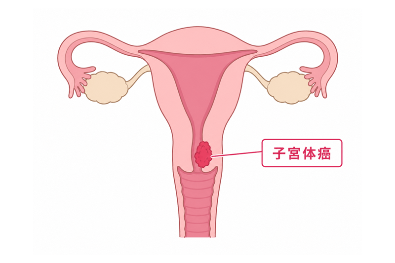 子宮頸癌（子宮頸部異形成）について | 川越レディースクリニック