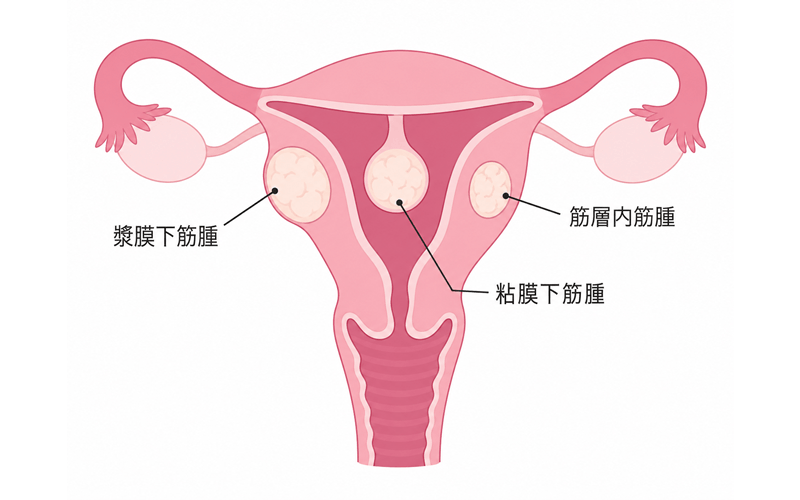 子宮筋腫